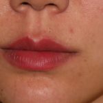 Lip Fillers Before & After Patient #315