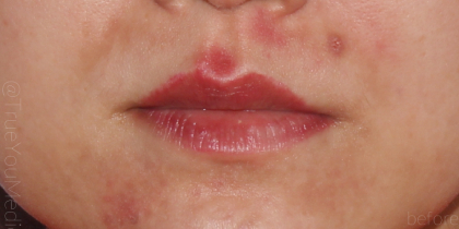 Lip Fillers Before & After Patient #316