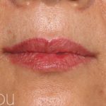 Lip Fillers Before & After Patient #321