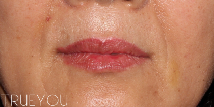 Lip Fillers Before & After Patient #321