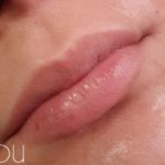 Lip Fillers Before & After Patient #324