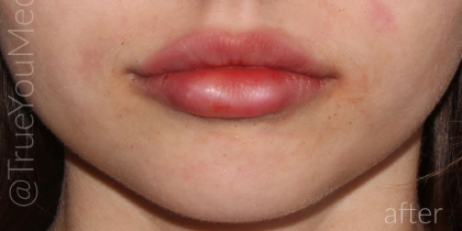 Lip Fillers Before & After Patient #317