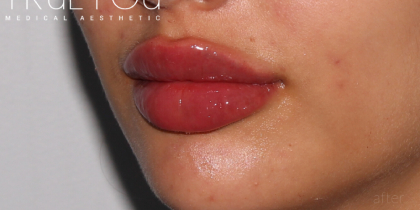 Lip Fillers Before & After Patient #318