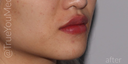 Lip Fillers Before & After Patient #319