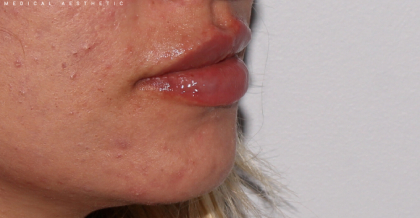 Lip Fillers Before & After Patient #320