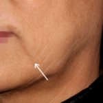 Juvederm Fillers Before & After Patient #270