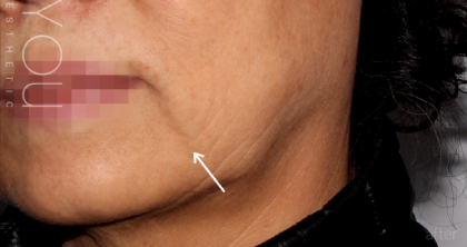 Juvederm Fillers Before & After Patient #270